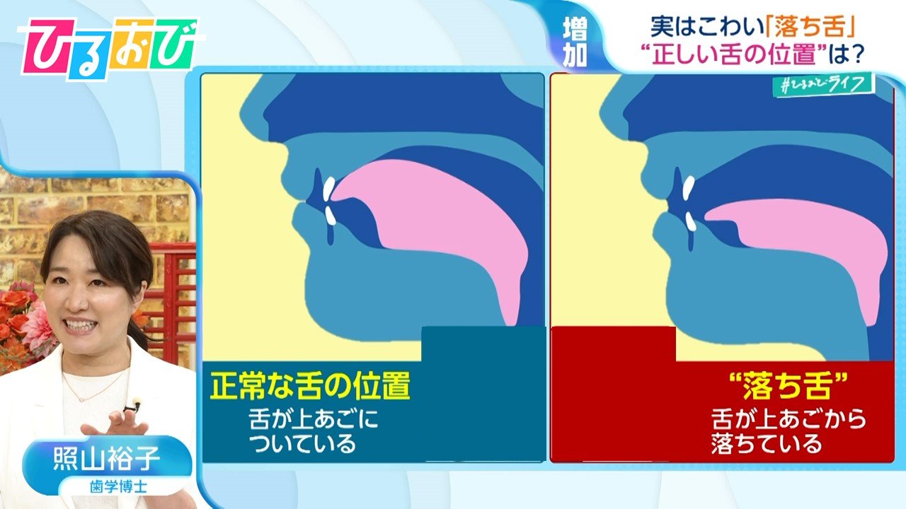 実はこわい『落ち舌』 2人に1人傾向が…“正しい舌の位置”を保つ「グミ」を使ったトレーニングを歯科医が伝授【ひるおび】