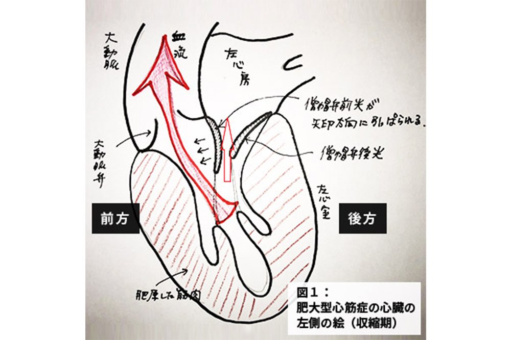 遺伝的要因も…心臓の筋肉が分厚くなる「肥大型心筋症」と「僧帽弁閉鎖不全症」～『ブラックペアン』監修ドクターが解説 vol.12～