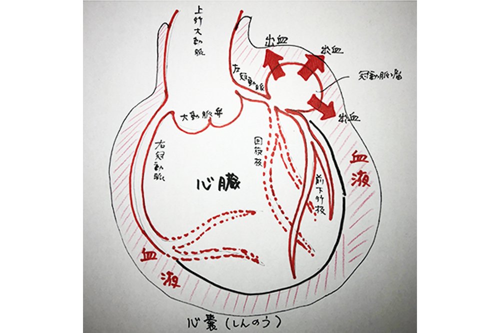 同時に併発？「冠動脈瘤」と「心タンポナーデ」とは？～『ブラックペアン』監修ドクターが解説 vol.14～