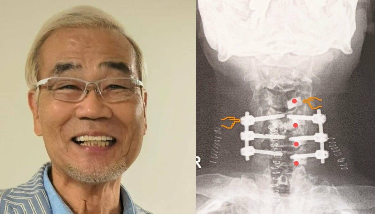 【 オール巨人 】 「今 首には11個の人工物が」 6回目の頸椎手術から半年 「術後.本当に二度と漫才は出来ない 人生が終わった思ってました」「こんなしんどい辛い半年に成るとは」