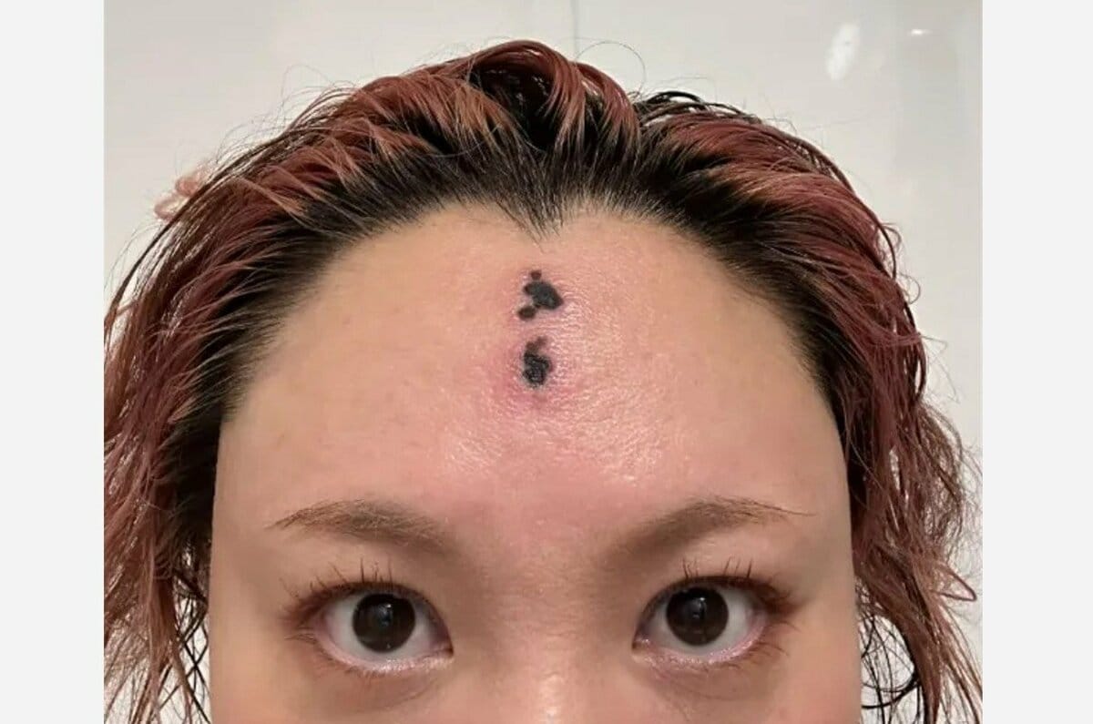 【 バービー 】 「ただの悪化した虫刺されです」 SNSにつづる 「Instagramがこの額を梵字のタトゥーと認識したのか…」 ファンも心配 「跡残らず治ります様に、、」