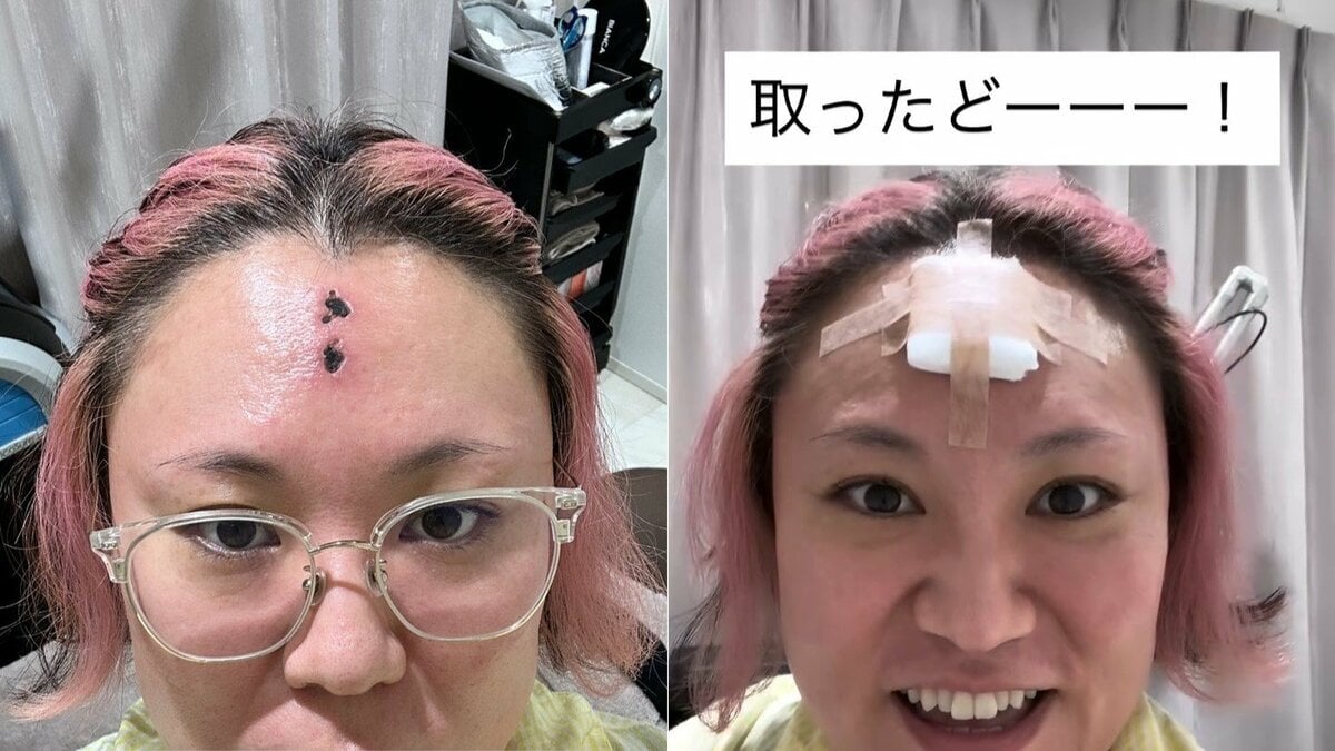 【 バービー 】額のかさぶたを手術で「取ったどーーー!」 “みんなの心配 胸に沁みたよ” フォロワーの声に感謝