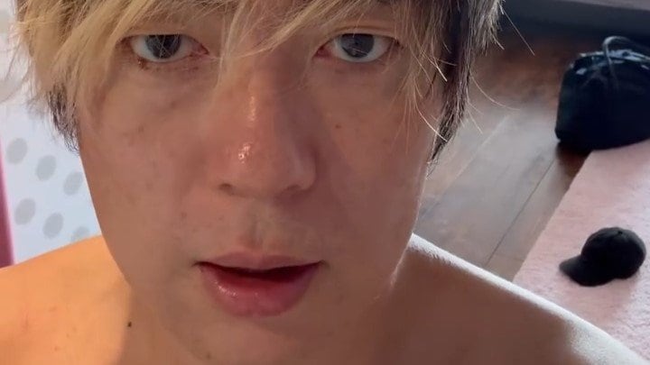 【 村本大輔 】クラゲに刺されて全身に腫れ「救急車で運ばれた」「失神しそうに」今後アナフィラキシーショックの危険も【ウーマンラッシュアワー】