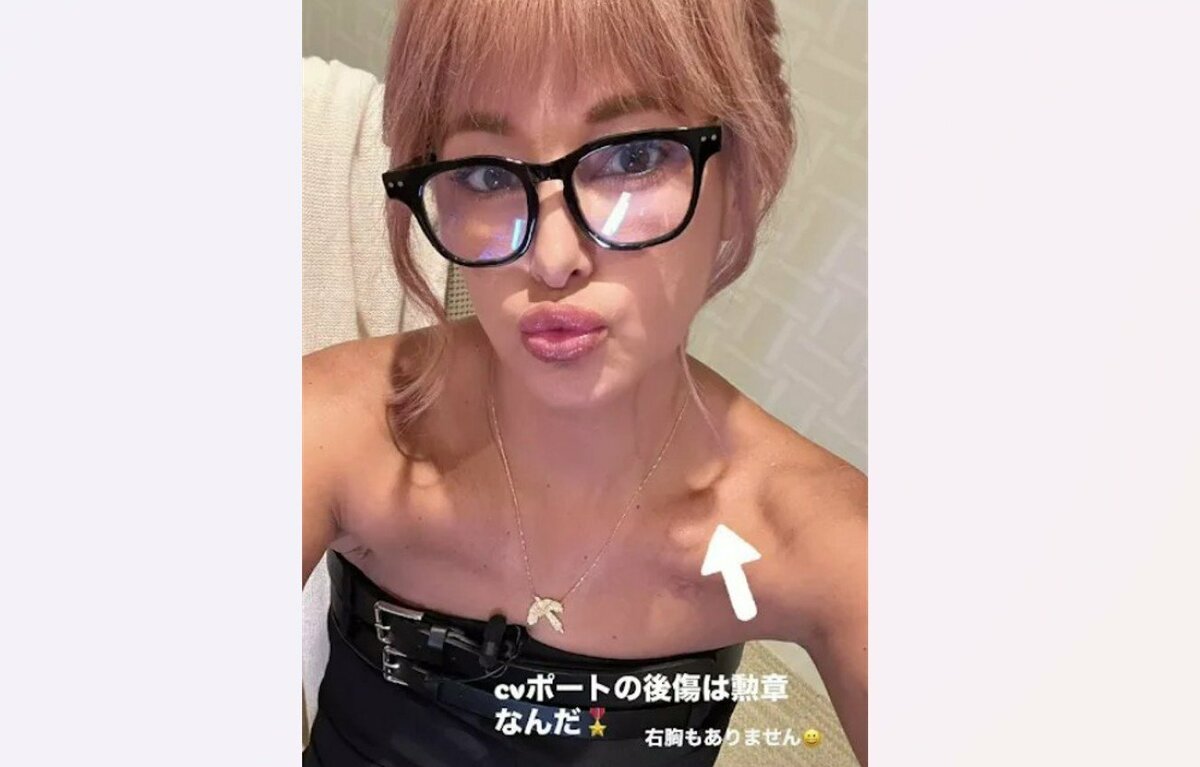 【 梅宮アンナ 】 「cvポートの後傷は勲章なんだ」　鎖骨あたりに残る傷跡を公開　「右胸もありません」　明るく報告