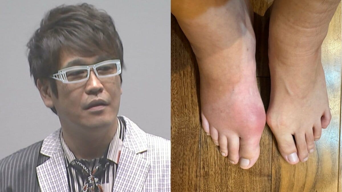 【 古坂大魔王 】痛風で「風が吹かなくてもいてーよ！」　右脚が腫れて「痛無風だよ！」