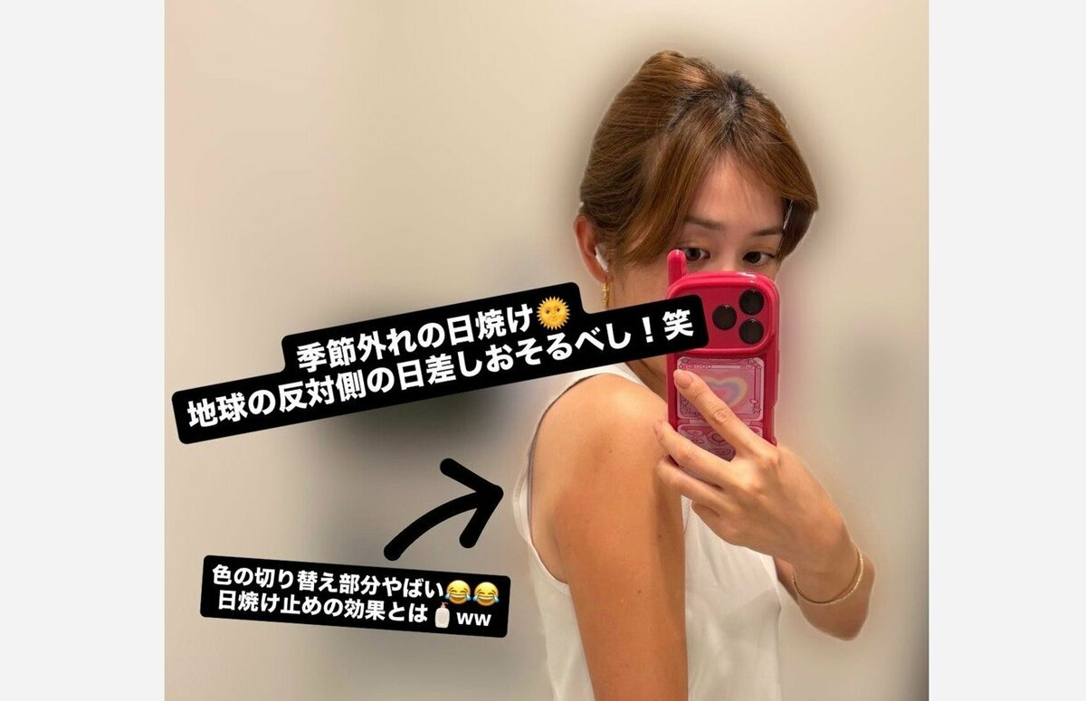 【 中川安奈 】 「季節外れの日焼け 地球の反対側の日差しおそるべし!笑」「本当に日焼けしやすい体質で笑笑」