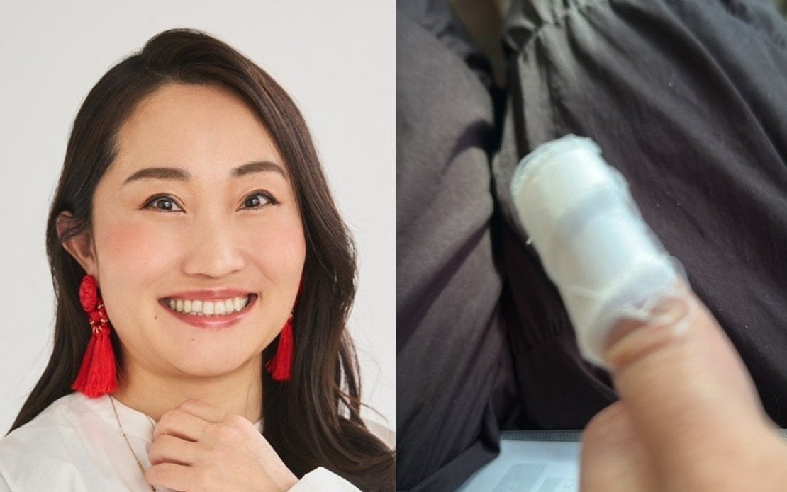 【 キンタロー。 】　火傷で病院に「2度だった」　「R1準決勝だめで落ち込んでいたら」「素手で熱々の鍋の蓋を持つと言う失態を」　「めちゃくちゃ火傷痛いので」うずくまる