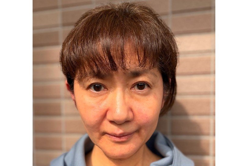 【 がん闘病 】古村比呂さん「蕁麻疹がポツポツと発生」「処方された抗生剤の薬アレルギーでした」