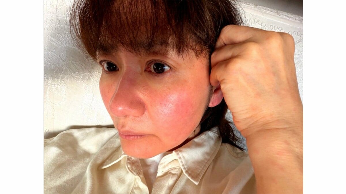 【 がん闘病 】古村比呂さん　薬アレルギーの状況明かす　「痒みと赤みが治らず前から約束していた事を急遽お断りしてしまいました」