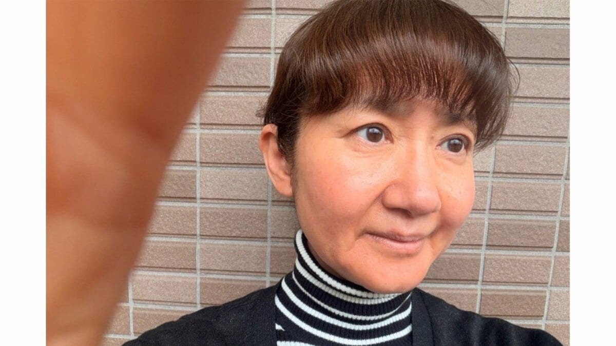 【 がん闘病 】古村比呂さん　薬アレルギーの現況　「赤みや浮腫みの治りは今までで一番良い感じ」　ブログで明かす　「あとは痒み！」