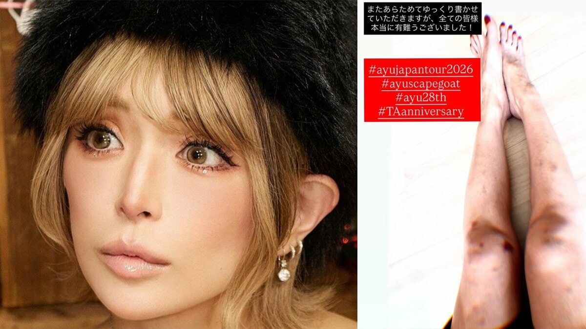 【 浜崎あゆみ 】 「誇らしいでしかない傷だらけの脚」 ツアー開幕直後 〝満身創痍〟な脚を公開 「一緒にツアーの幕開けへ向けて闘い抜いてくれた」