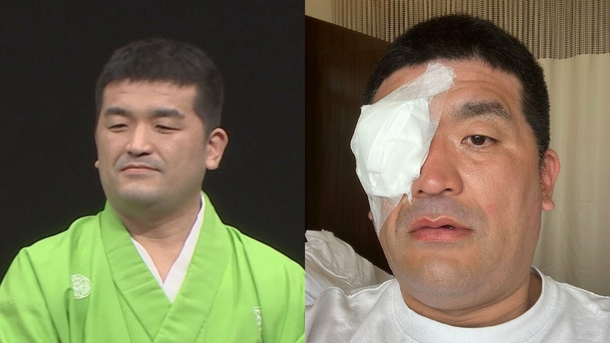 【 すゑひろがりず・三島達矢 】　右目白内障で手術　「手術時間も短く無事に成功」　 SNSに本人明かす　「原因はアトピーの合併症らしく」