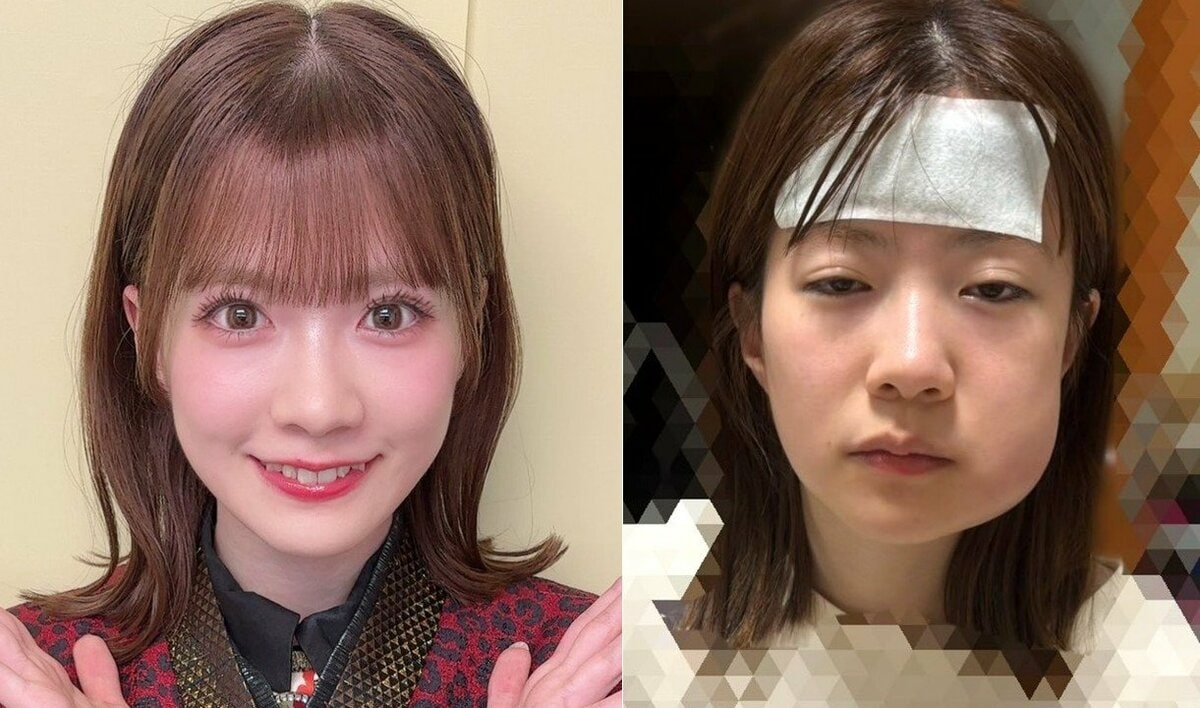 【 NMB48・松岡さくら 】 「アイドルのオンとオフ 」 投稿写真にWEB騒然 「オンとオフの差すごっ!笑笑」「めっちゃ腫れすぎてる!」「同一人物なの?笑」