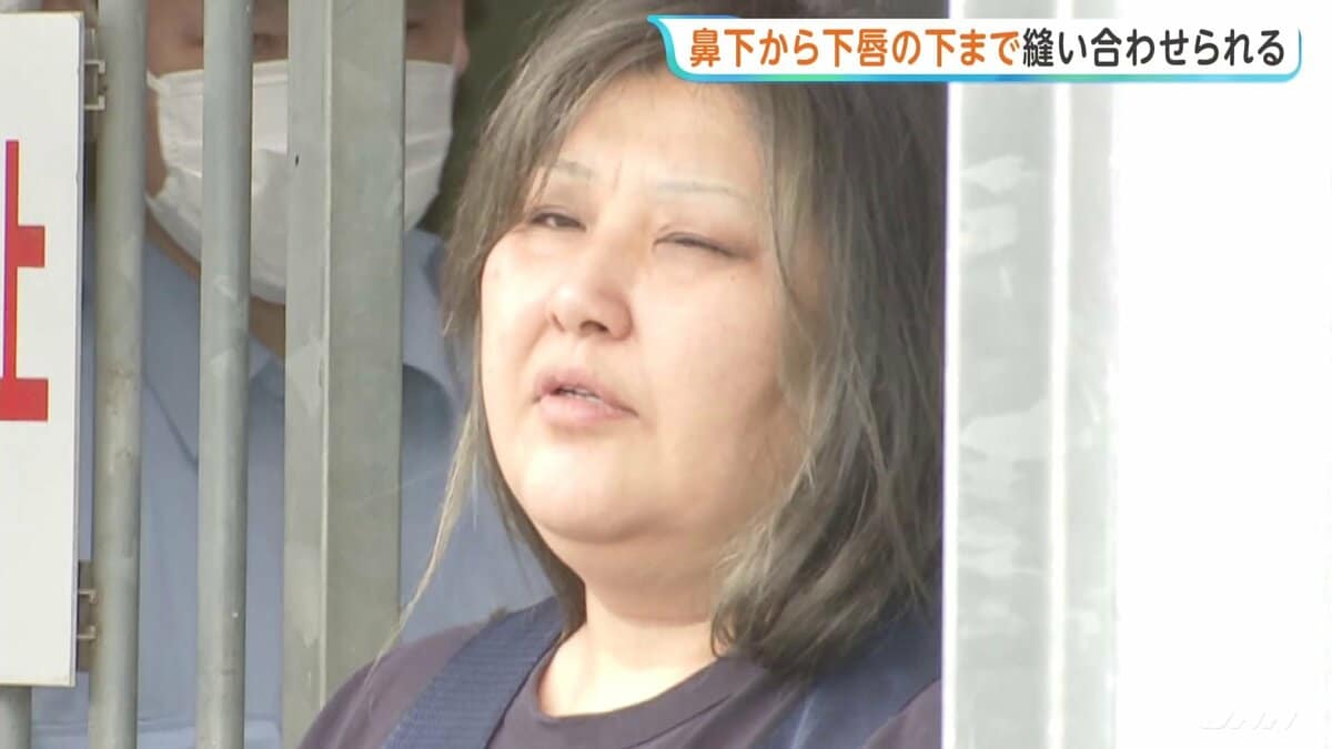 鼻の下から下唇の下までを口の中に糸を通す形で縫われる 女性の唇を縫い付け49歳女が逮捕された事件 茨城・古河市