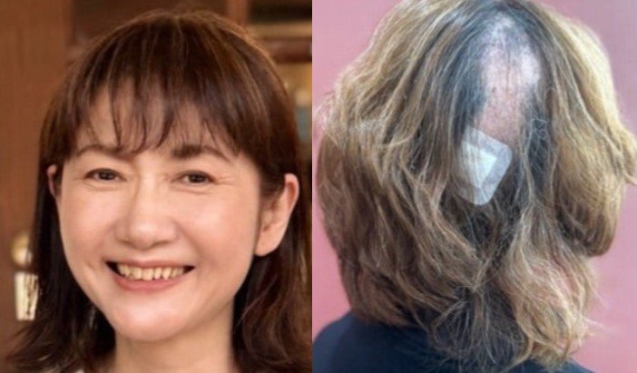 【 がん闘病 】古村比呂さん「頭皮の帯状疱疹になって 髪の毛が部分的にごっそりと抜けてから 約1年」「見事に生えてきました」