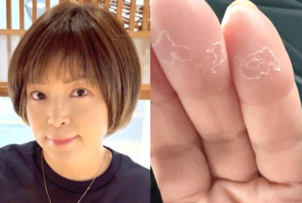 【 がん闘病 】石原詢子 抗がん剤の副作用を吐露「ここのところ、足の浮腫が尋常じゃなく・・」「手足の指の痺れ、、そして手の指の皮がめくれてきて痛い」