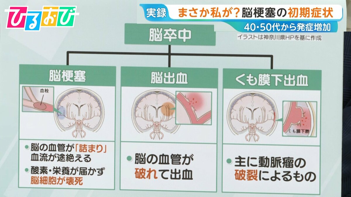 40代から増加「脳梗塞」の初期症状は?「倒れてからじゃ遅い」早期発見のカギ「BE FAST」とは【ひるおび】