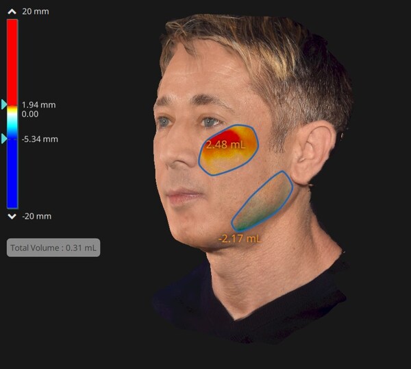 Experts Agree On the Longevity of EMFACE's Non-Invasive Face-Lifting ...