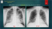 ノーベルファーマ、世界初の自己免疫性肺胞蛋白症治療薬を提供開始＿専門医と患者がそのポイントを語る