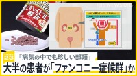 “紅麹サプリ”大半の患者が「ファンコニー症候群」か、具体的な症状は？ 4分の3ほどは服用中止で症状改善「必要以上に怖がらず、不調があれば受診を」【news23】