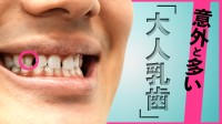 大人になっても乳歯のまま…その割合「10人に1人」　生え変わるはずの永久歯がない「大人乳歯」の対処法