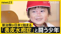 全身に水疱ができる皮膚の難病「表皮水疱症」と闘う男の子　最新の治療薬の治験が日本で始まる【news23】