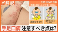 手足口病が全国で“警報レベル” アルコール消毒は効果なし？食事や水分は？子どもの異変をチェック【Nスタ解説】