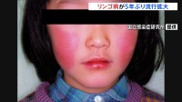 「リンゴ病」が5年ぶりの流行拡大　妊娠中の女性は注意が必要