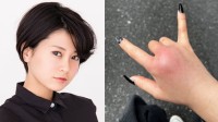 【 RaMu 】　ペットに噛まれ「蜂窩織炎」に　３８度超えの高熱も　「1週間2種類の点滴生活を強いられている」「指動かないしめちゃ激痛」
