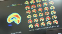 「ブレインフォグ」解消の糸口掴む コロナ後遺症患者の脳を分析「アンパ受容体」の密度が健常者より高いと判明 横浜市立大学病院の研究結果「治療法開発につながる成果」