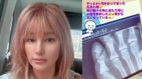 【 梅宮アンナ 】　左足小指を再び骨折　乳がん闘病中に悲痛な報告…「骨がもろくなっている」　治療の副作用への不安も吐露