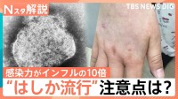 はしか「発症の1日前から感染力」「風邪のような症状のあとに発疹」26～53歳は特に注意！ワクチン接種歴の確認を【Nスタ解説】