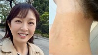 【 丸岡いずみ 】　人生初の毛虫被害で皮膚炎に　「こんなに痒いのね」　GWのキャンプや露天風呂が原因か