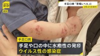 手足口病 2週連続で「警報レベル」1医療機関あたり9.12人　厚労省は手洗いの徹底など呼びかけ