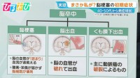 40代から増加「脳梗塞」の初期症状は？「倒れてからじゃ遅い」早期発見のカギ「BE FAST」とは【ひるおび】