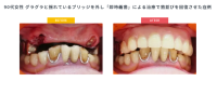 いとう歯科医院が保険適用で対応する入れ歯相談会を開催
