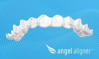 パリ裁判所による廃止済み機能に関する判決、Angelalignの顧客への影響は最小限の見込み