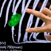 悪性腫瘍で『骨を３本失った犬』…手術から２週間後→まるで嘘のような『８歳を迎えた光景』に感動「よく頑張った…！」「泣けてくる」の声